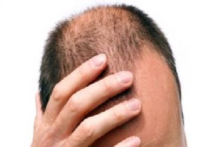 Saç Dökülmesinin Başlıca Sebebi Erkeklik Hormonu