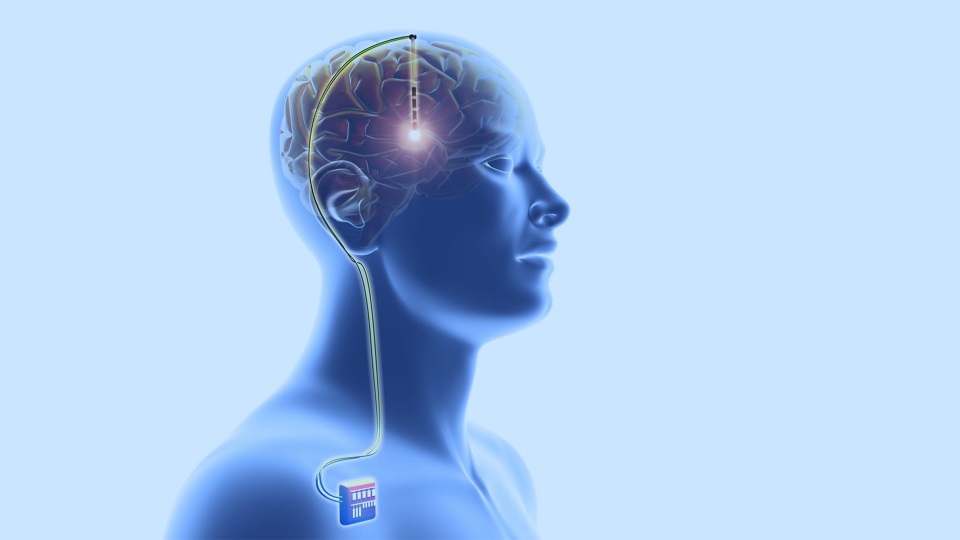 Uzmanı açıkladı: Parkinson hastalarında beyin pili hayatı kolaylaştırıyor!