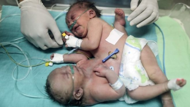 Gazzeli yapışık ikizler S.Arabistan da yapılan ameliyatla ayrıldı