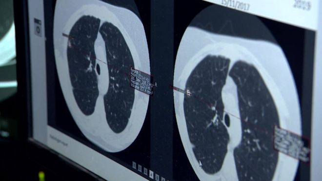 İngiltere de kalp hastalıkları ve akciğer kanseri yapay zeka ile teşhis edilecek
