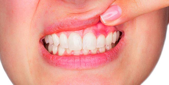 Diş apsesi nedir? Çeşitleri nelerdir?