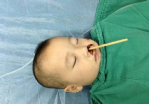 Çin de 2 yaşındaki bebeğin beyninden çubuk çıkarıldı!