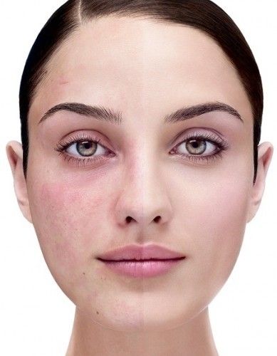 Yüzünüzde Gizli Olan 8 Hastalık Belirtisine Dikkat!!! - 7. fotoğraf