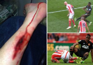 Şok! Futbolcunun Ayağı Delik Deşik Oldu!