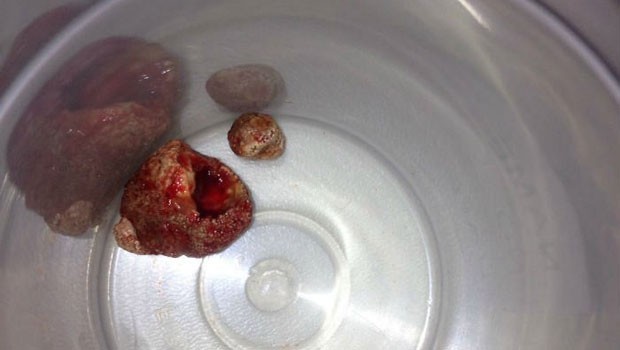 Tükürük bezinden 3 santimetrelik...