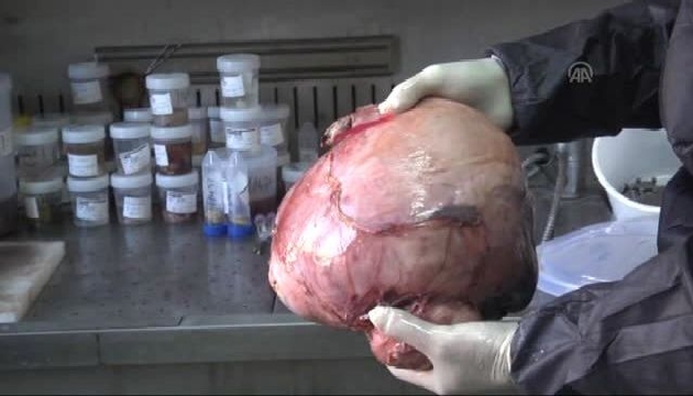 Kadın 6 kilogramlık tümörle 8 yıl yaşadı!