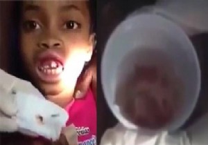 Şok! Şok! Şok! Küçük kızın diş etinden tam 15 kurtçuk çıktı!