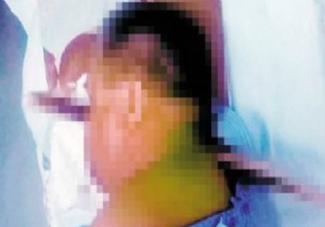 Yüzüne Saplanan Kazıkla Hastaneye Koştu!