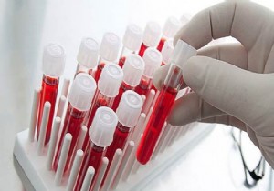 Alzheimer Hastalığı Kan Grubu Arasında Sıkı Bağ Var!