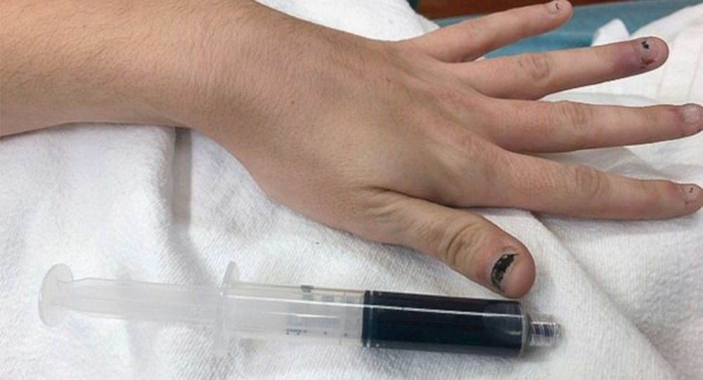 25 yaşındaki kadının kanı, içtiği ilaç yüzünden mavi renge döndü