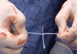 Tıpta Eriyen Stent Devrimi