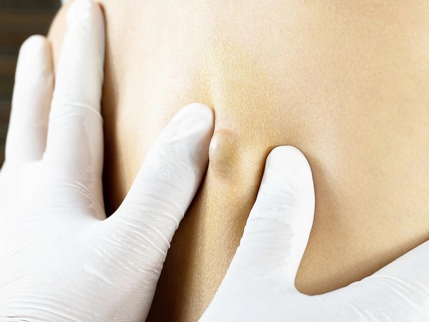 Dermatoloji Uzmanı Koç: Dermoid kistler tümör gibi görünebilir