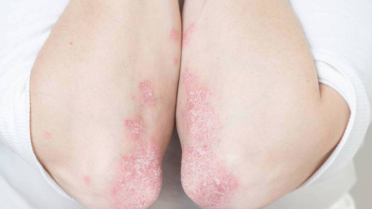 Doktorlar uyardı: “Kelebek hastalığı” lupus hayati organları etkileyebiliyor