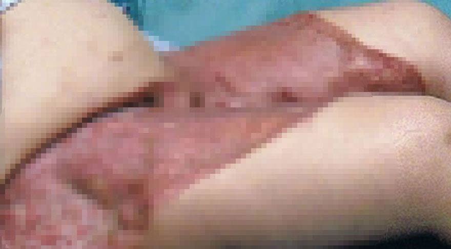 Genital bölgesini traş edince hayatı zehir oldu