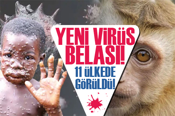 Maymun virüsü 11 ülkede görüldü! Maymun çiçeği virüsünün tedavisi var mı?