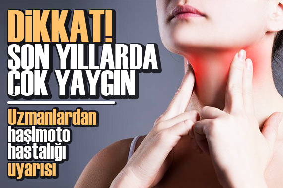 Son yıllarda çok yaygın! Uzmanlardan haşimoto hastalığı uyarısı