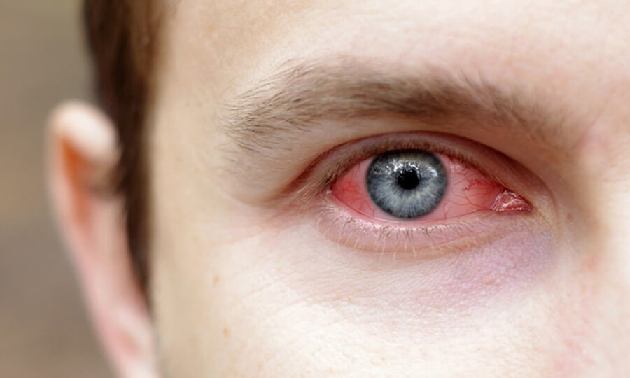 Kırmızı göz hastalığı alarmı! Vaka sayısı 86 bini geçti