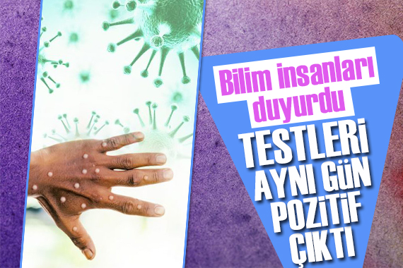 Bilim insanları duyurdu: Maymun çiçeği, Covid-19 ve HIV´in aynı anda bulunduğu vaka