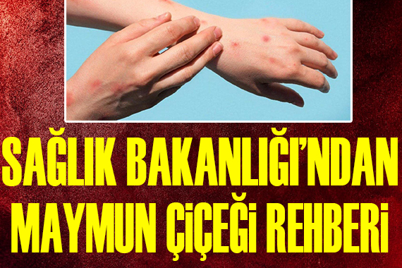 Sağlık Bakanlığı ndan maymun çiçeği rehberi!