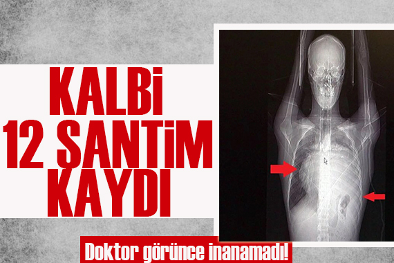 Kalbi 12 cm sağa kaydı, doktor görünce inanamadı!