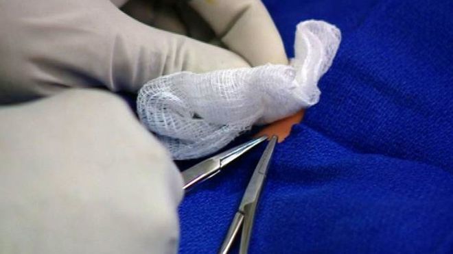 İtalya’da evde sünnet edilen bir bebek öldü, ikizi ağır yaralandı