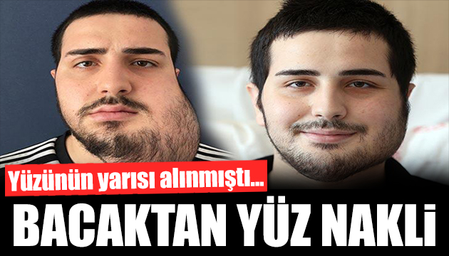 Yüzünün yarısı alınan hastaya bacağından yeni yüz yapıldı