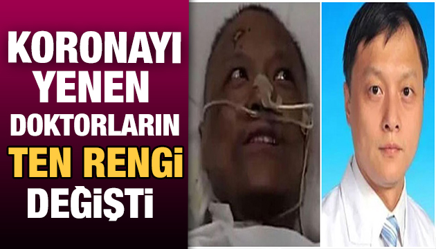 Korona virüsü yenen doktorların ten rengi değişti