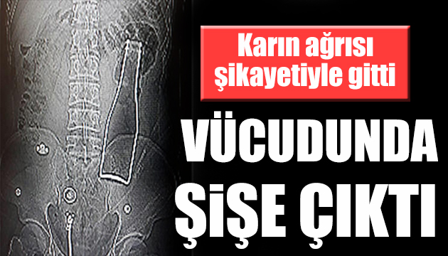 Karın ağrısı şikayetiyle gitti vücudunda şişe çıktı