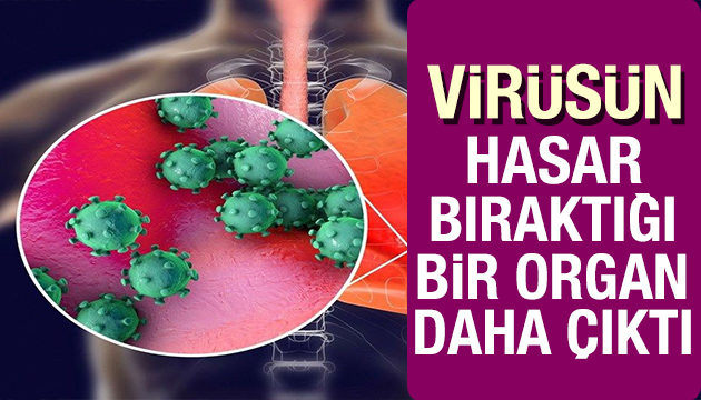 Korona virüsün hasar bıraktığı bir organ daha çıktı