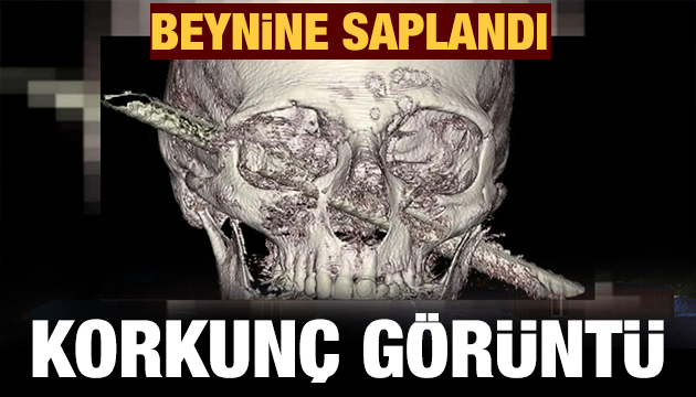 Korkunç görüntü! Beynine saplandı