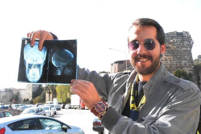 Doktorlar beyninde diş buldu!