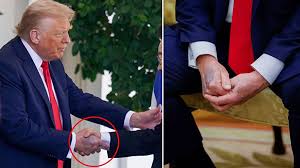 Trump ın elindeki morluk dikkat çekti