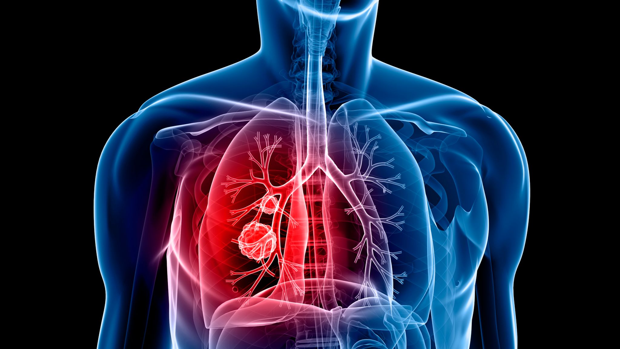Akciğer kanseri önlenebilir mi?