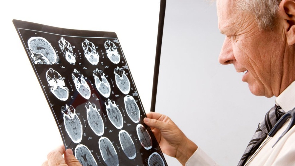 Alzheimer ve kabızlık arasında şaşırtan ilişki