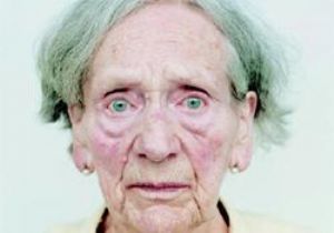 Alzheimer Artık Genç Hastalığı 