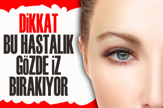 Dikkat! Bu hastalık gözde iz bırakıyor