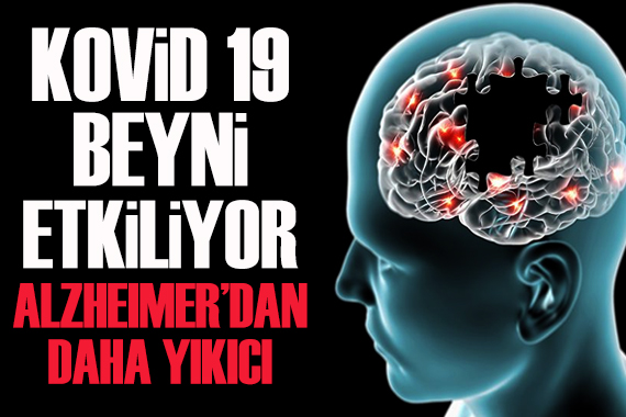 Kovid 19 beyni etkiliyor: Alzheimer dan daha yıkıcı