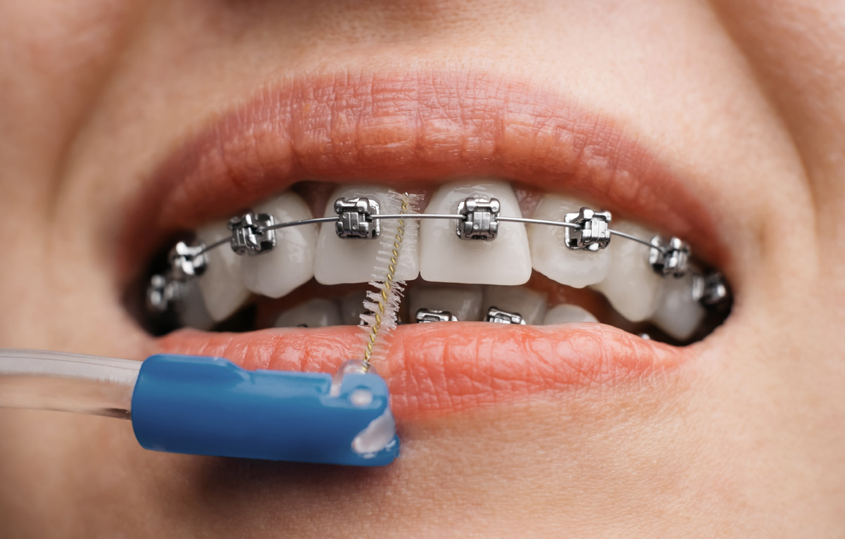 Diş Doktoru Samira Murad uyardı: Ortodontik tedavide hijyen önemli