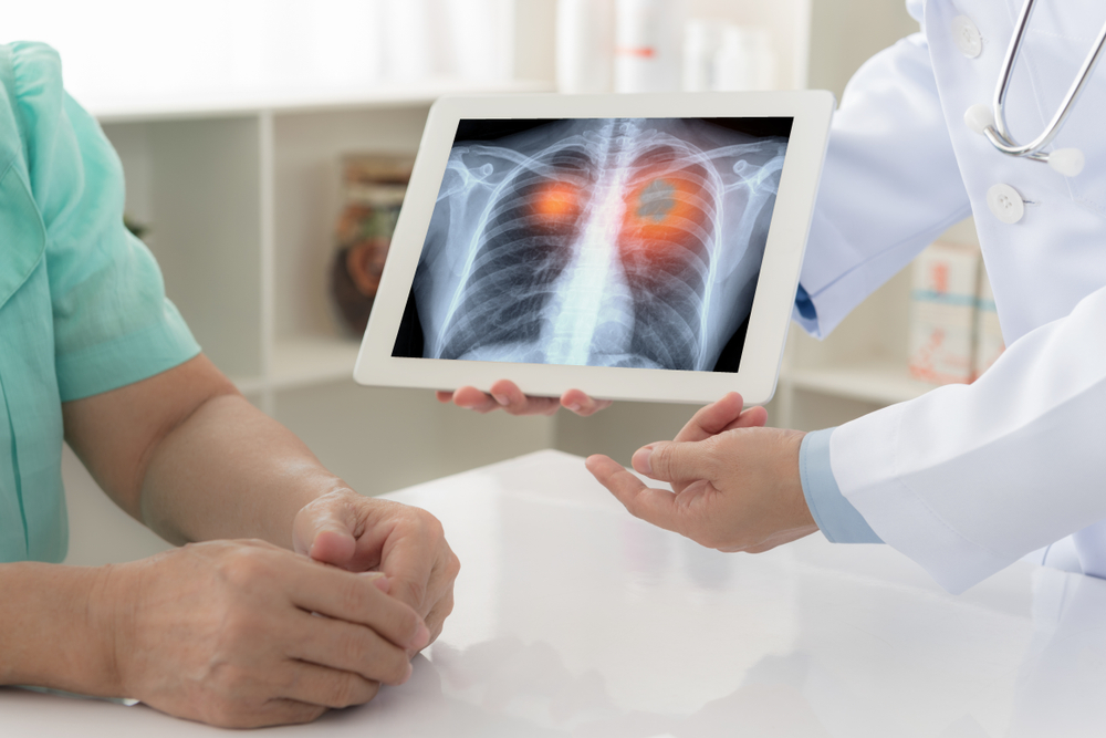 Her yıl 41 bin kişi akciğer kanserine yakalanıyor!