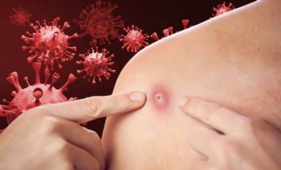 KDC’de Mpox alarmı: 5 ayda 9 binden fazla vaka