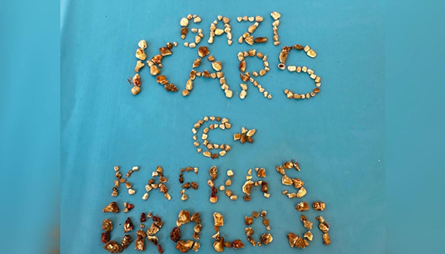 İki böbreğinden 300 den fazla taş çıktı