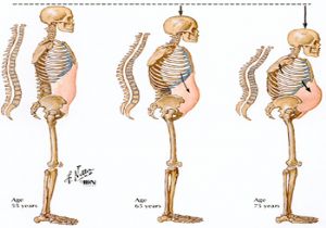 Osteoporoza Çipli Tedavi