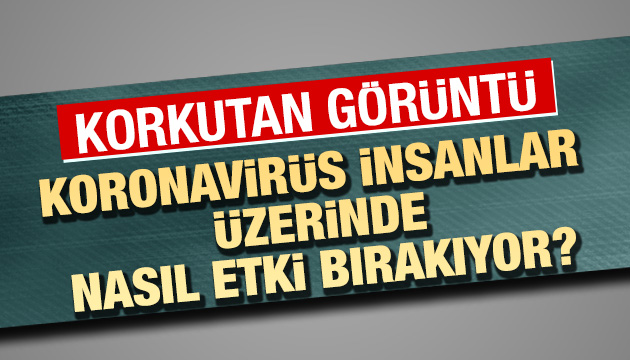 Koronavirüsün insan üzerinde etkisi ortaya çıktı