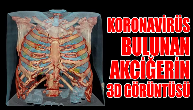 İşte koronavirüs bulunan akciğerin 3D görüntüsü