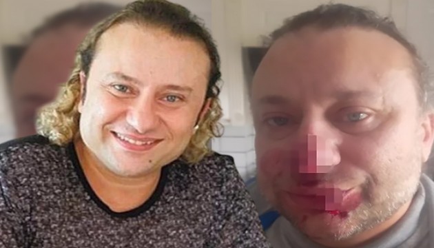 'Felaket tellalı' şarkıcı Pitbull saldırısına uğradı