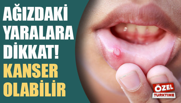 Ağızdaki yaralara dikkat! Kanser olabilir
