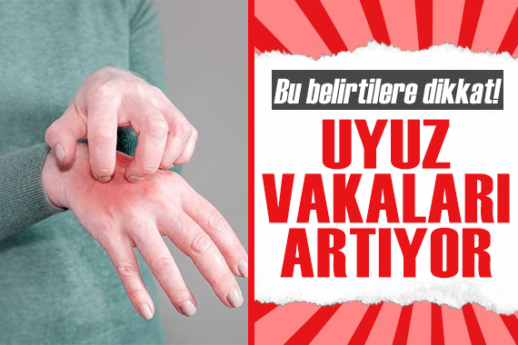 Uyuz vakaları artıyor: Bu belirtilere dikkat!