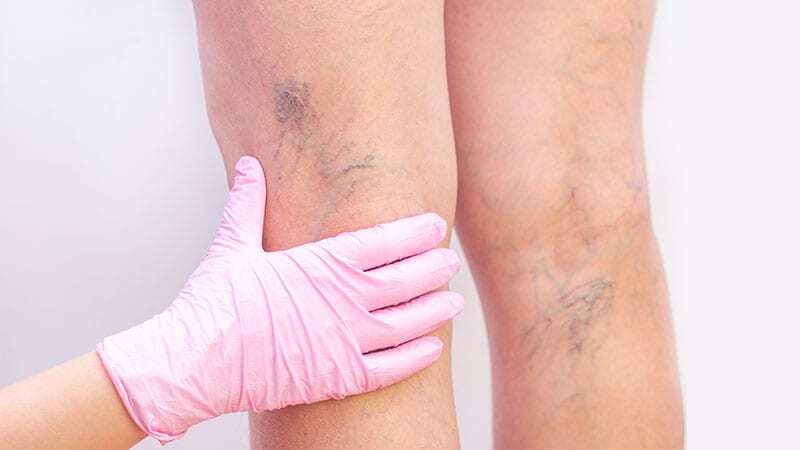 Uzmanı uyardı: Varis vücutta ‘Pıhtı’ riskini artırabilir