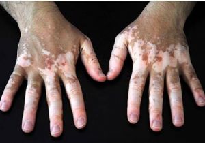 Vitiligo Tedavisinde Yeni Umut