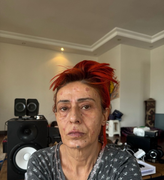 Yıldız Tilbe'nin tedavi süreci